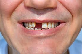 Dental Implants in Rohini Delhi